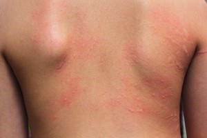 When to Worry About a Rash - Complete Care