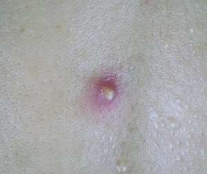abscesses