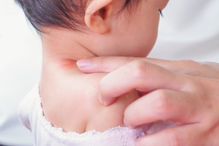 When to See a Doctor for Bug Bites Complete Care