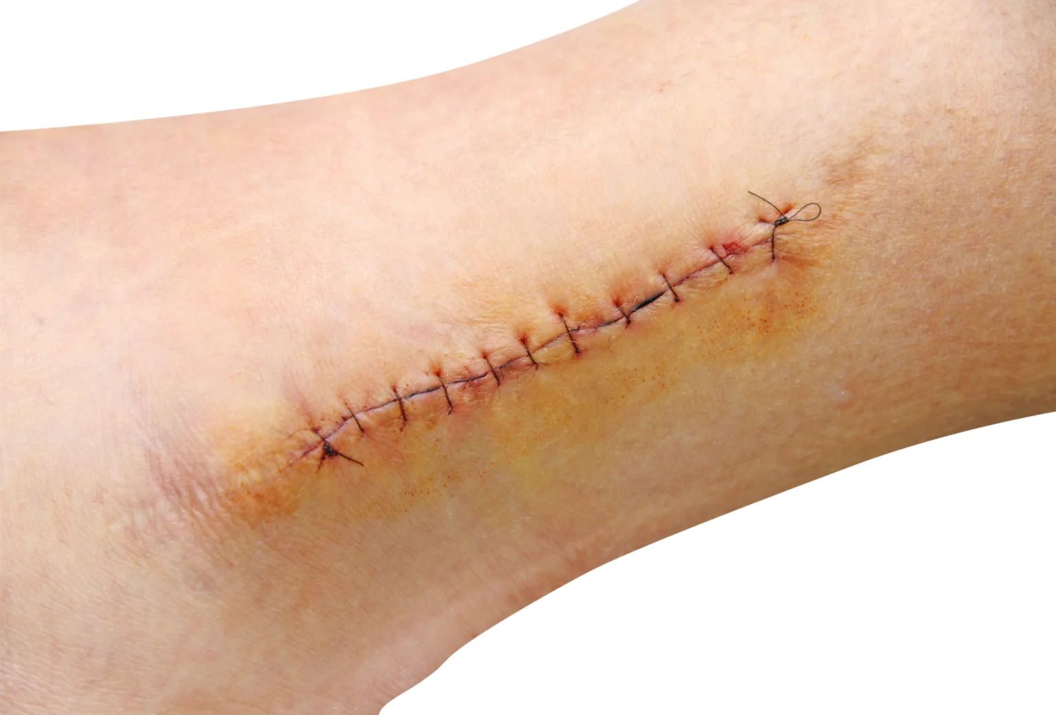 Infected Stitches: Symptoms, Pictures, Risk Factors, Treatment