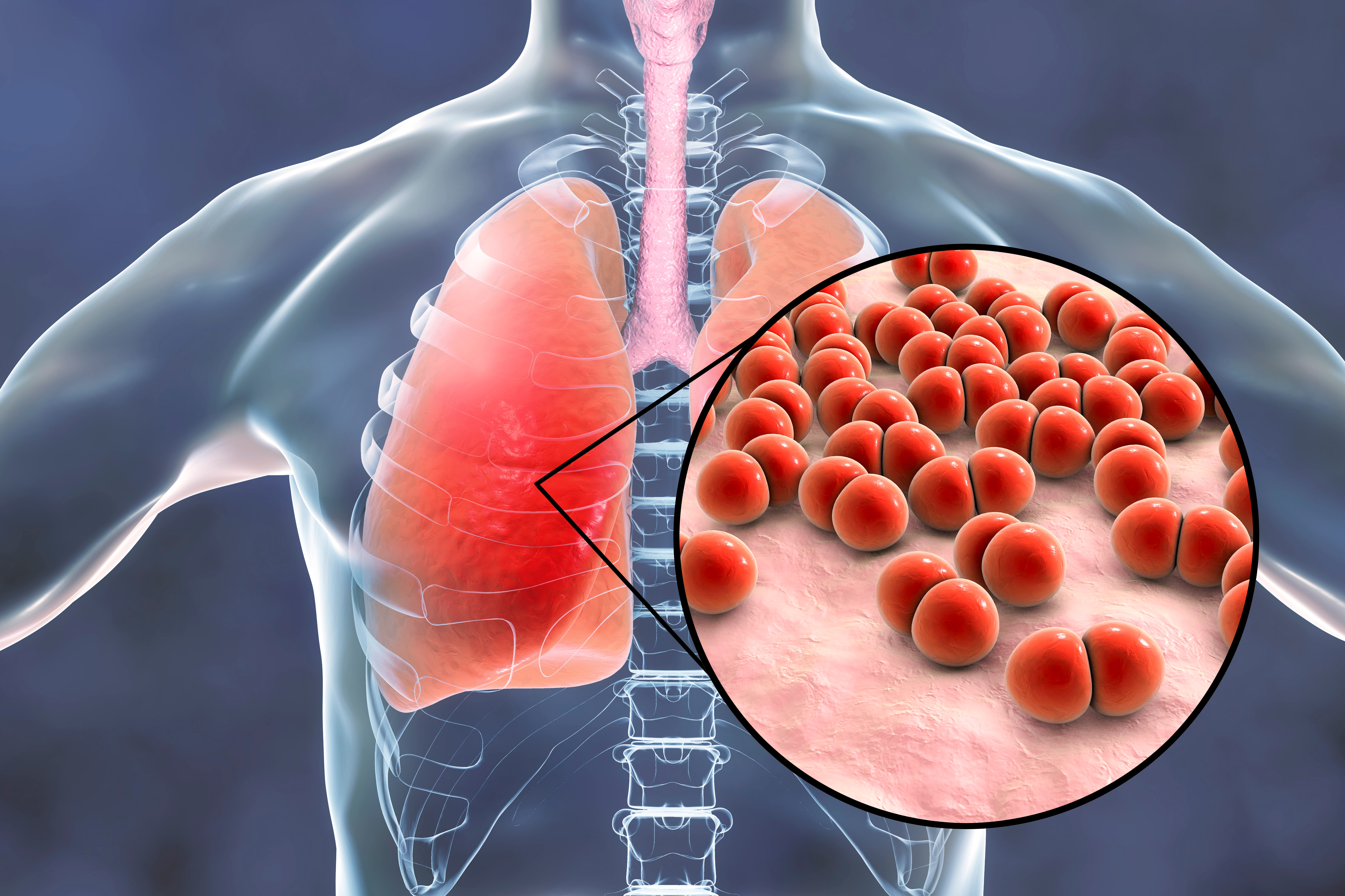 Bronchitis symptoms Bronchitis emergencies