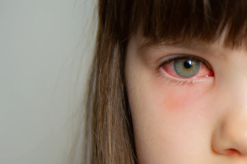 child with pink eye