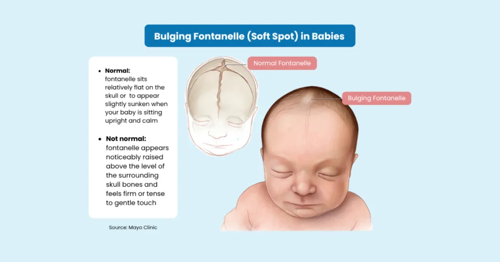 Bulging Fontanelle Causes And Treatment Complete Care