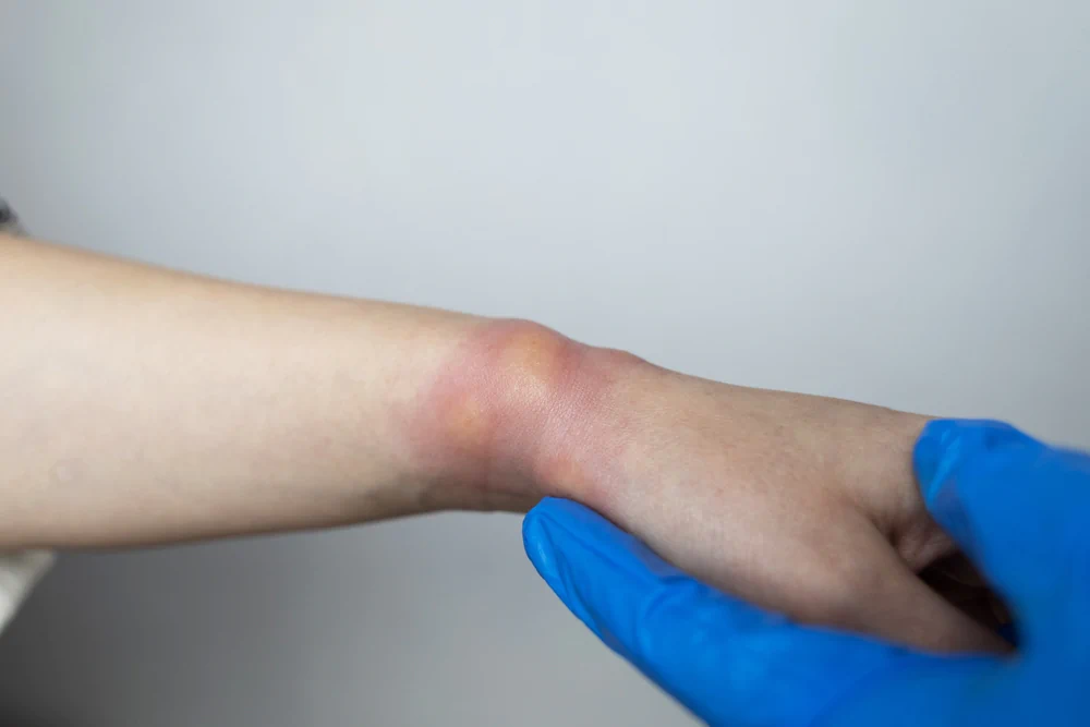 Emergency Treatment for Insect Bites and Stings