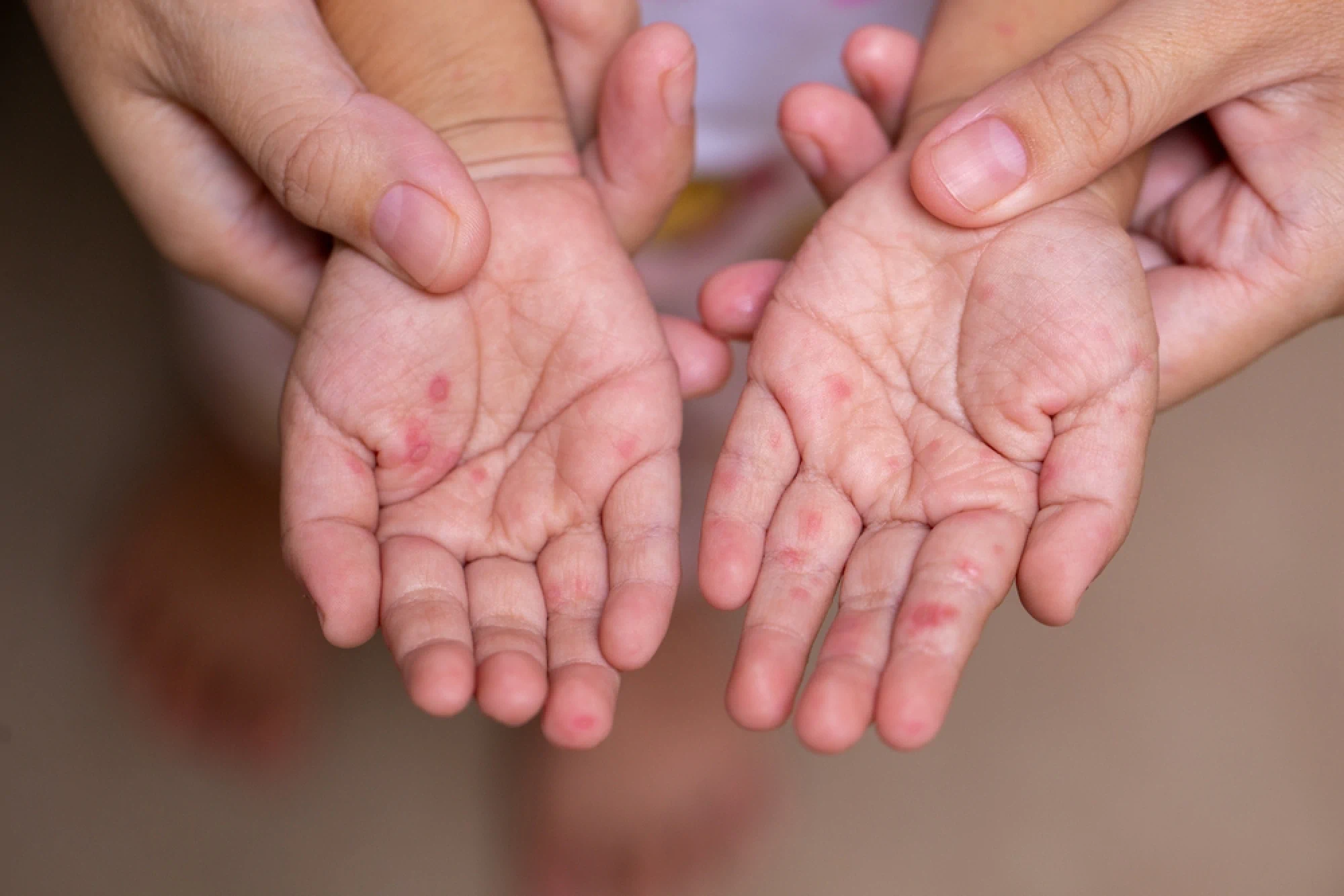 Hand, Foot, and Mouth Disease vs Roseola: How to Tell the Difference